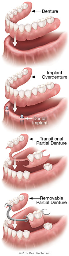 Removable Denture Types